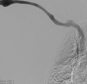 Image of central chest vein