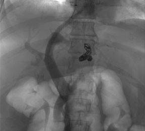 Image of gastric variceal embolization