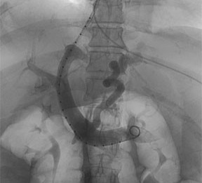 Image of gastric variceal embolization