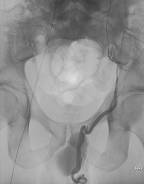 Image of male varicocele embolization