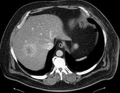 Image of radioembolization of liver tumors