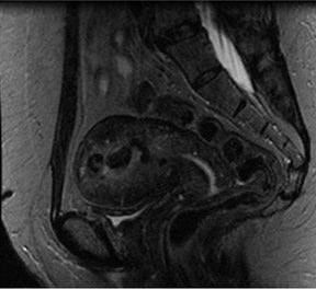 Image of uterine fibroid embolization